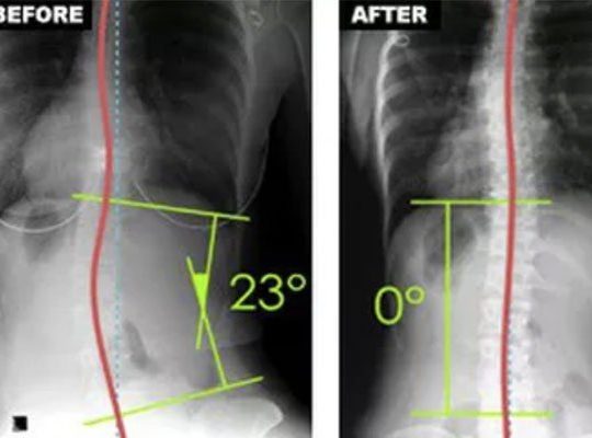 Clear Scoliosis
