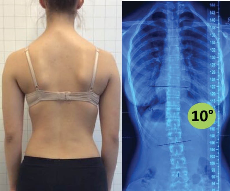 clear-scoliosis-after-min