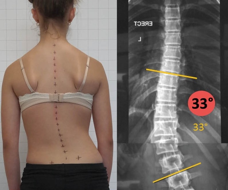 clear-scoliosis-before-min